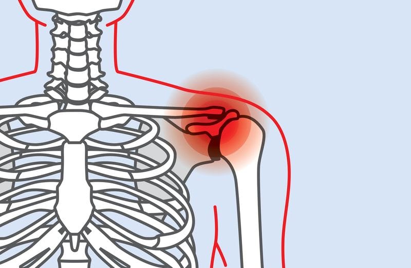 What is 'Frozen Shoulder'?
